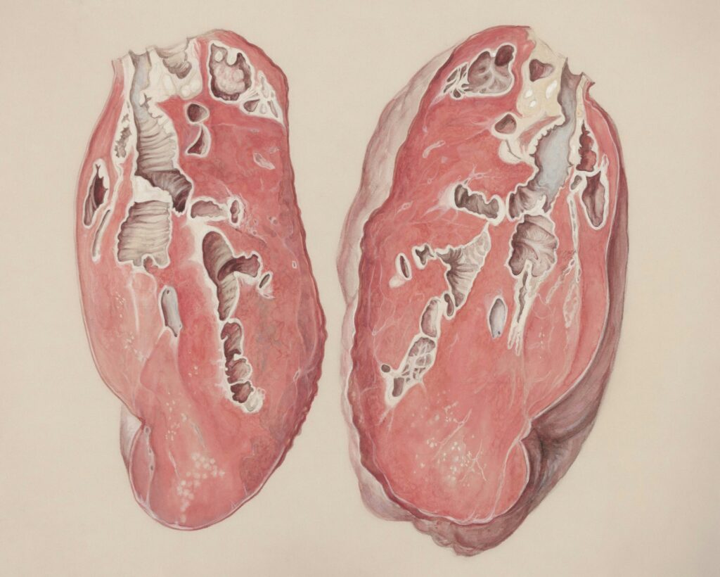 Psoriasis and Inflammation