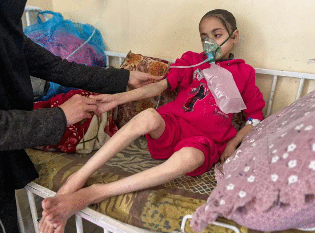 gaza child condition due to malnutrition